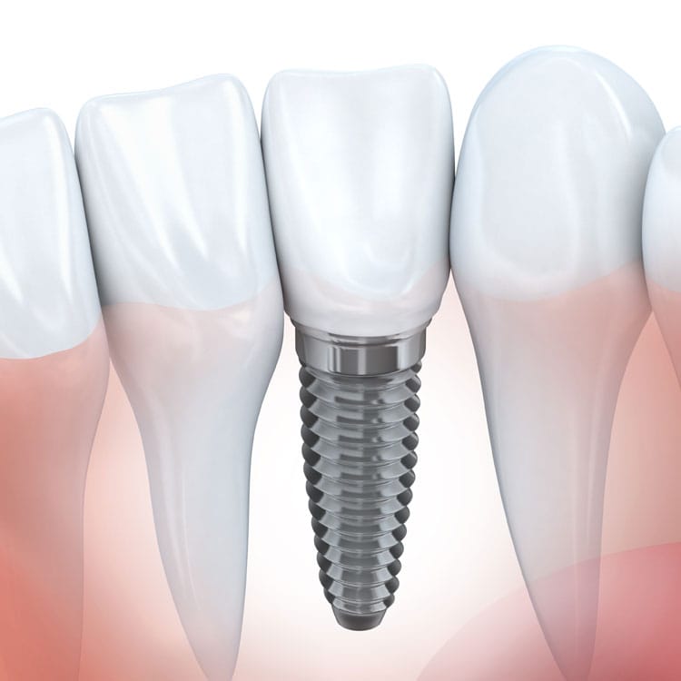 Implant Dentistry, dental implants innisfil, innsifil dentist, innisfil dental implants, alliston dentist, cookstown dentist, Cookstown Dentist, Innisfil Dentist, Thornton Dentist, Alliston Dentist, Bradford Dentist, Bond Head Dentist