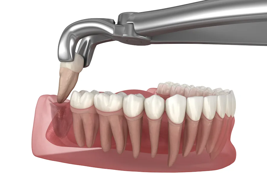 wisdom tooth extraction cookstown
