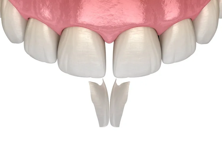 tooth bonding cookstown