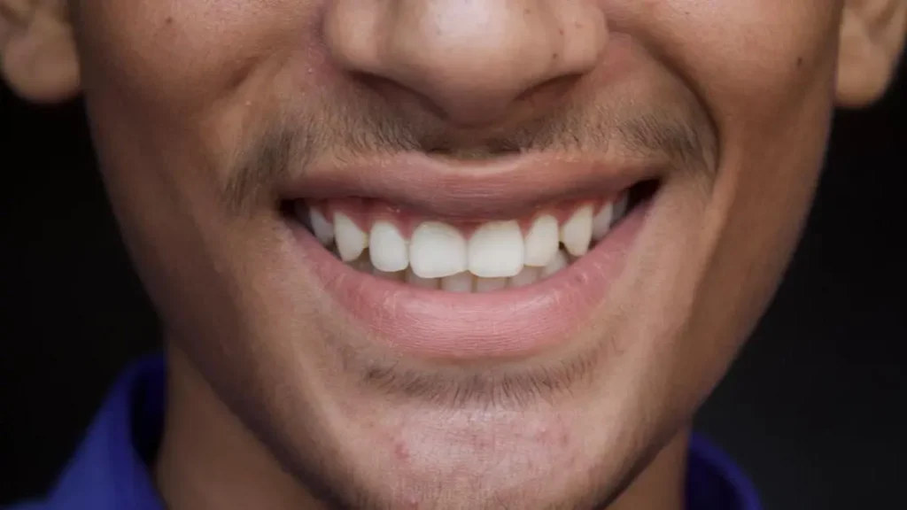 Can Veneers Fix Slightly Crooked Teeth? Find Out