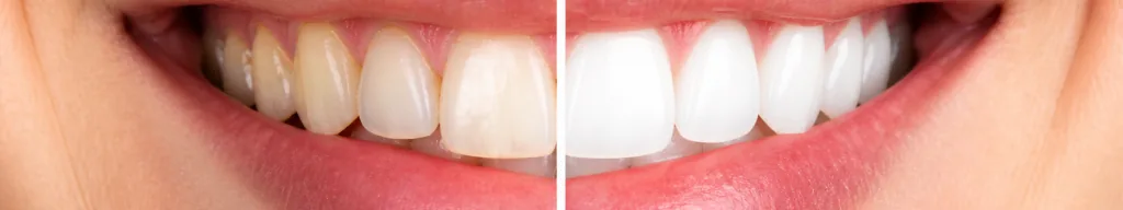Smile Makeovers