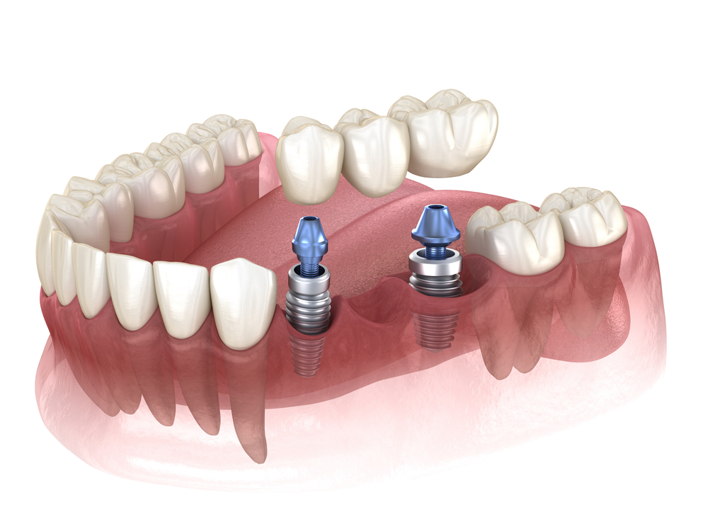 how do dental bridges work a step-by-step treatment guide
