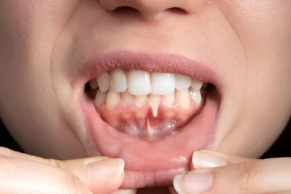 gum disease treatment in cookstown