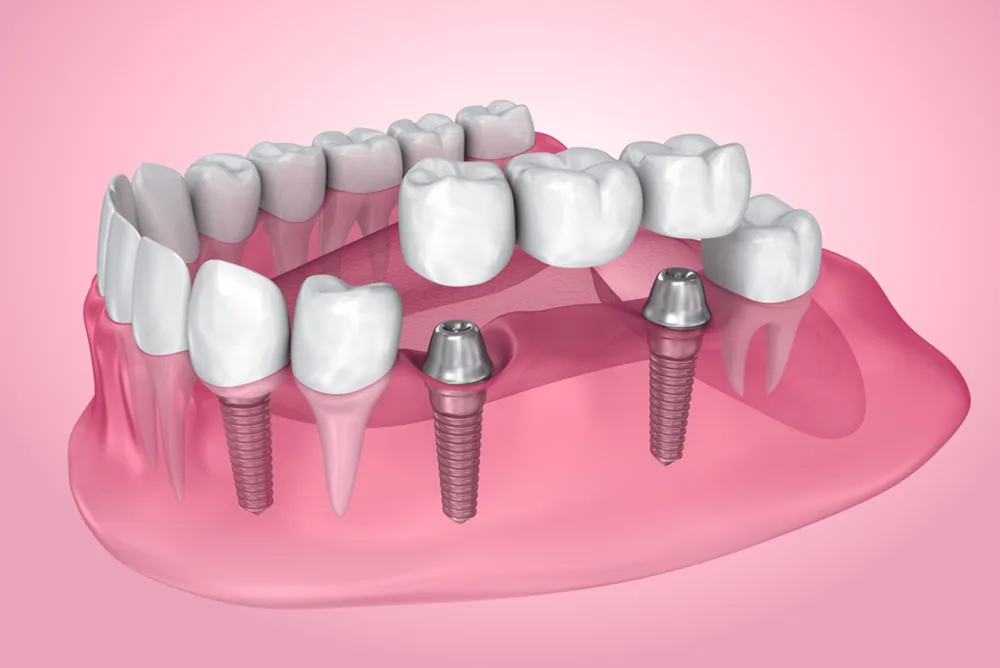 Dental crowns are a reliable solution to repair worn or broken teeth while enhancing your smile and overall dental function.