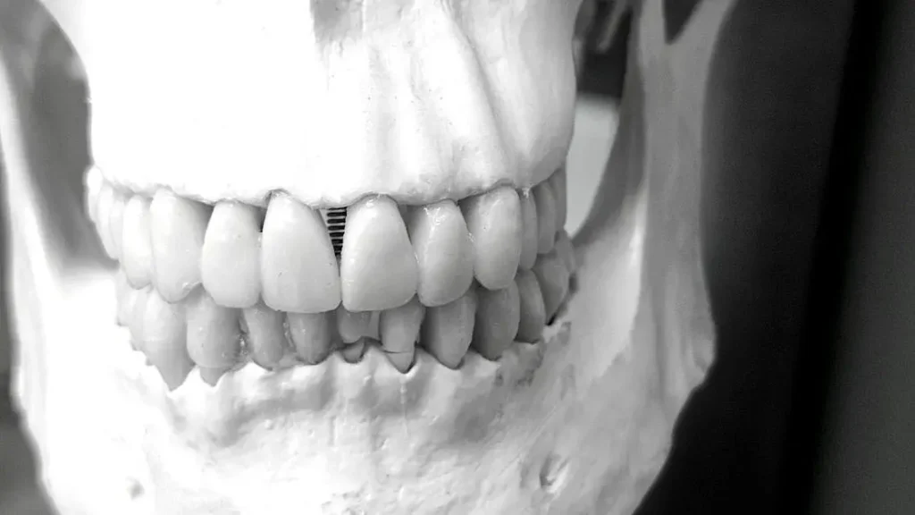 What Is Dental Implant Bone Grafting? Explained Simply