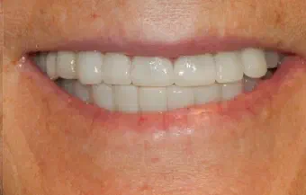 Smile after All-on-X dental treatment, case 1