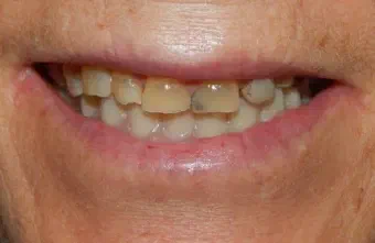 Smile before All-on-X dental treatment, case 1