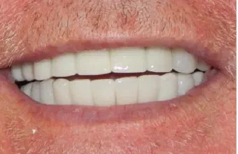 Smile after All-on-X dental treatment, case A
