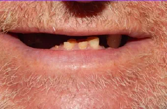 Smile before All-on-X dental treatment, case A
