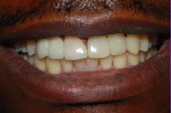 Smile after dental treatment, case 1
