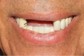 Smile before dental treatment, case 2