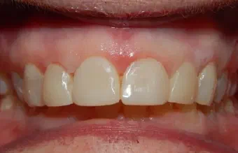 Smile after dental treatment, case 3