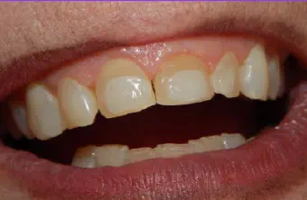 Smile before dental treatment, case 3