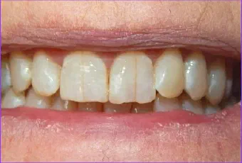 Smile before dental treatment, case 6