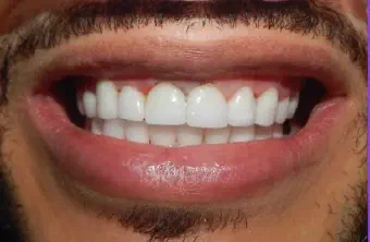 Smile after smile makeover treatment
