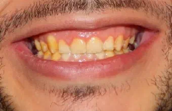 Smile before smile makeover treatment