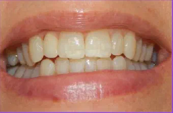 Smile after veneer treatment
