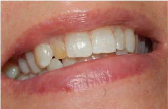 Smile before veneer treatment