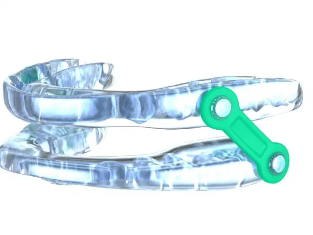 Custom sleep apnea oral appliance