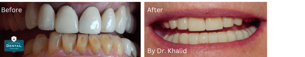 Smile Makeovers