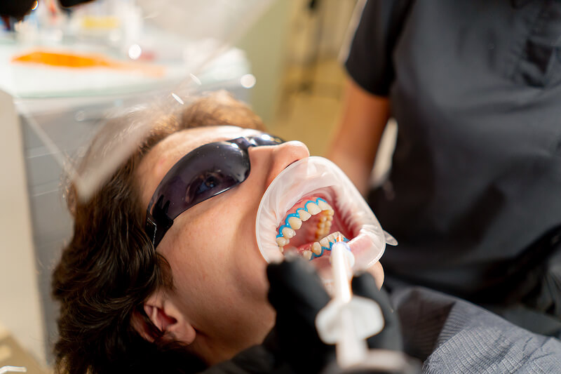 Closeup of a Professional Teeth Whitening service