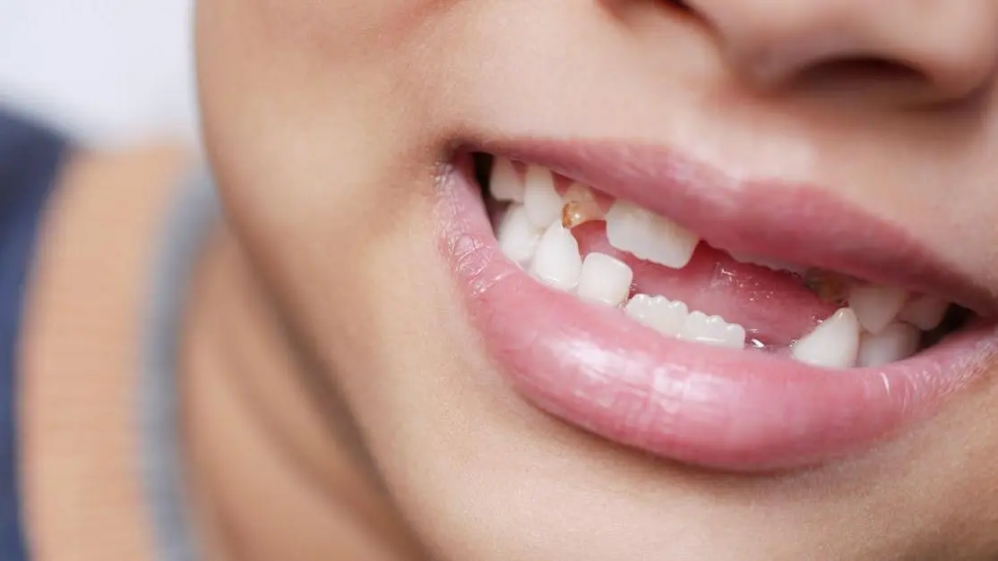 Child’s smile with missing teeth illustrating dental bridges Thornton options for kids