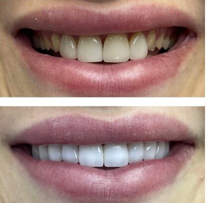 Permanent teeth in a day